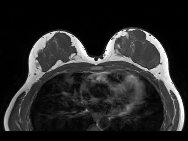 Ingenia Ambition 1.5T X: МРТ для онкологической диагностики всего тела за 30 мин.